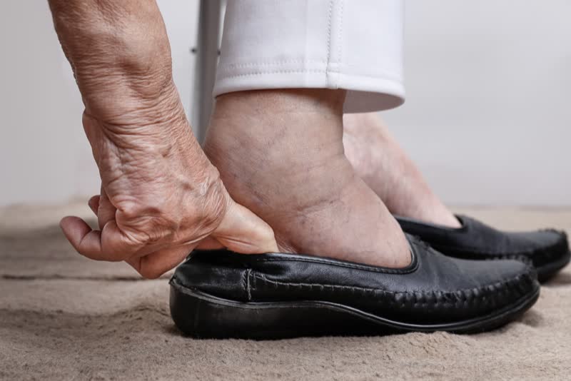 Edema a livello di piede e di caviglia in una persona anziana sintomo di insufficienza renale.